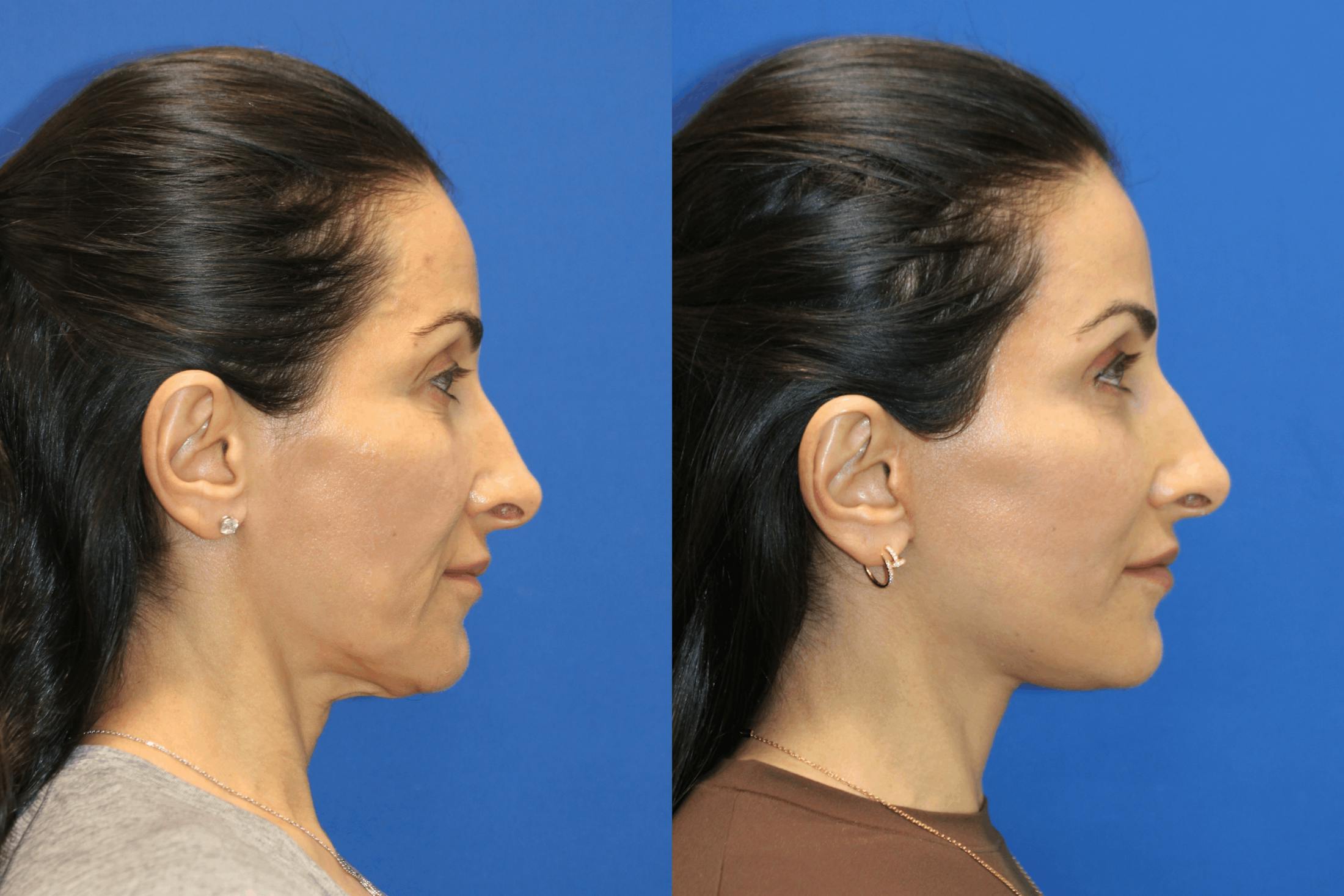 Vertical Restore® / Facial Rejuvenation Before & After Gallery - Patient 145535 - Image 3