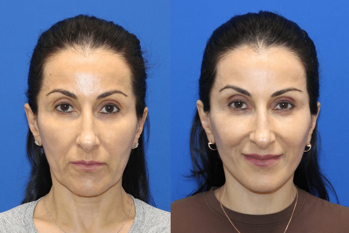 Vertical Restore® / Facial Rejuvenation Before & After Gallery - Patient 145535 - Image 1