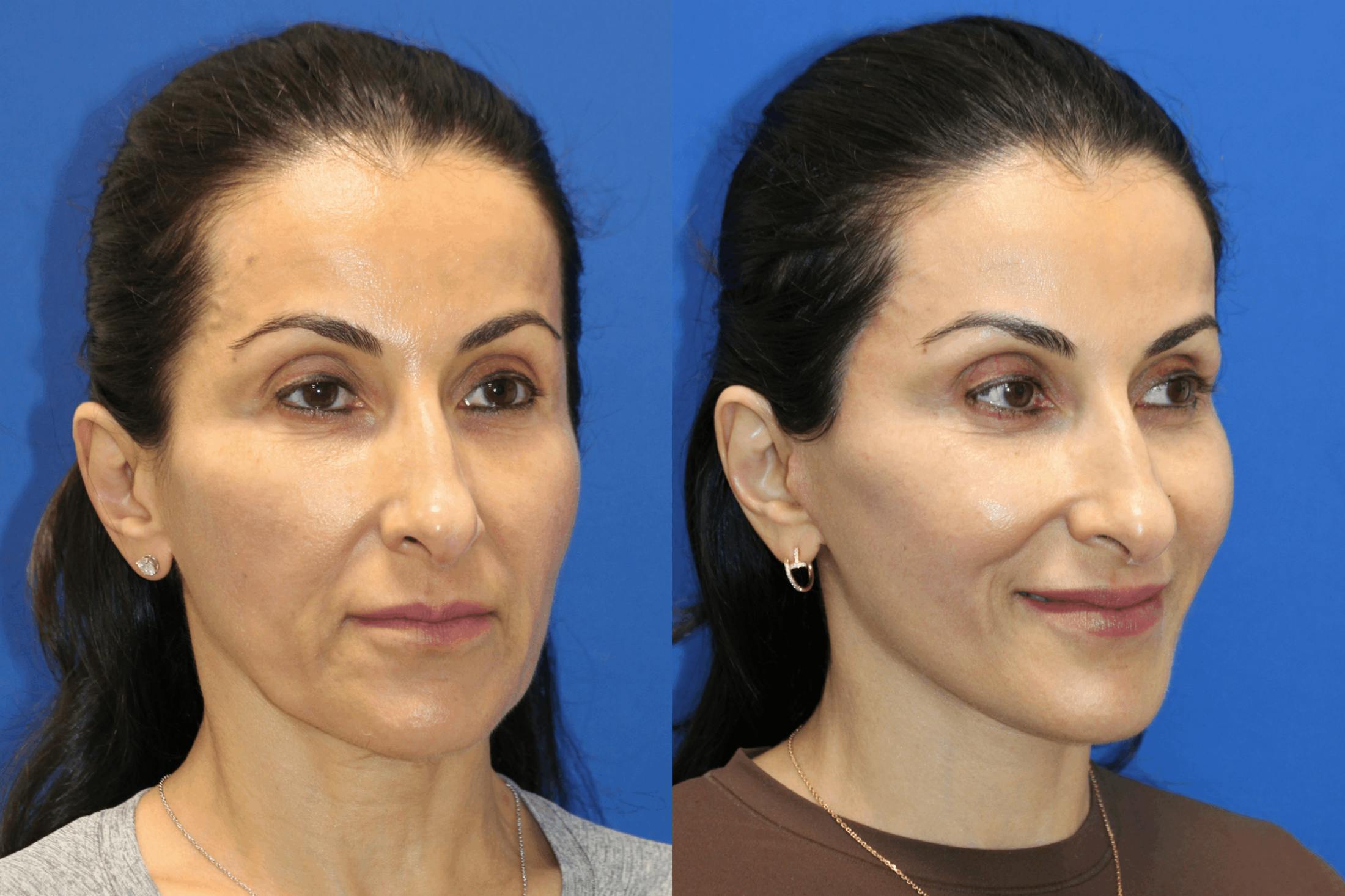 Vertical Restore® / Facial Rejuvenation Before & After Gallery - Patient 145535 - Image 2