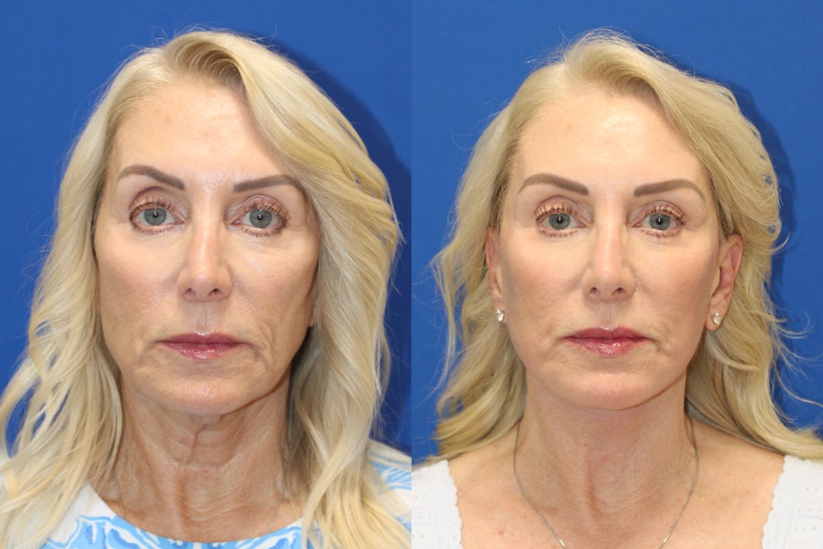 Vertical Restore® / Facial Rejuvenation Before & After Gallery - Patient 914685 - Image 1