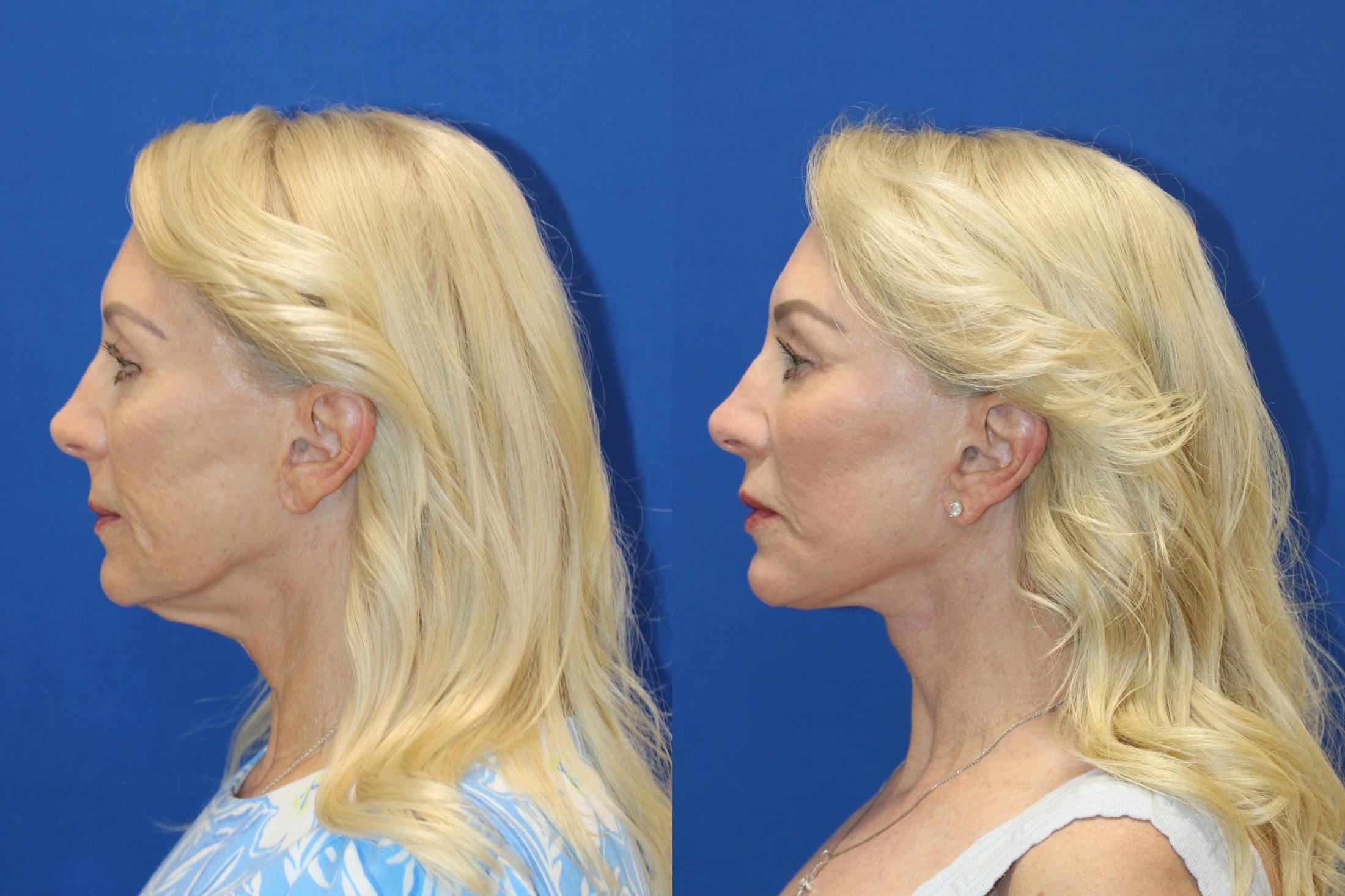 Vertical Restore® / Facial Rejuvenation Before & After Gallery - Patient 914685 - Image 2