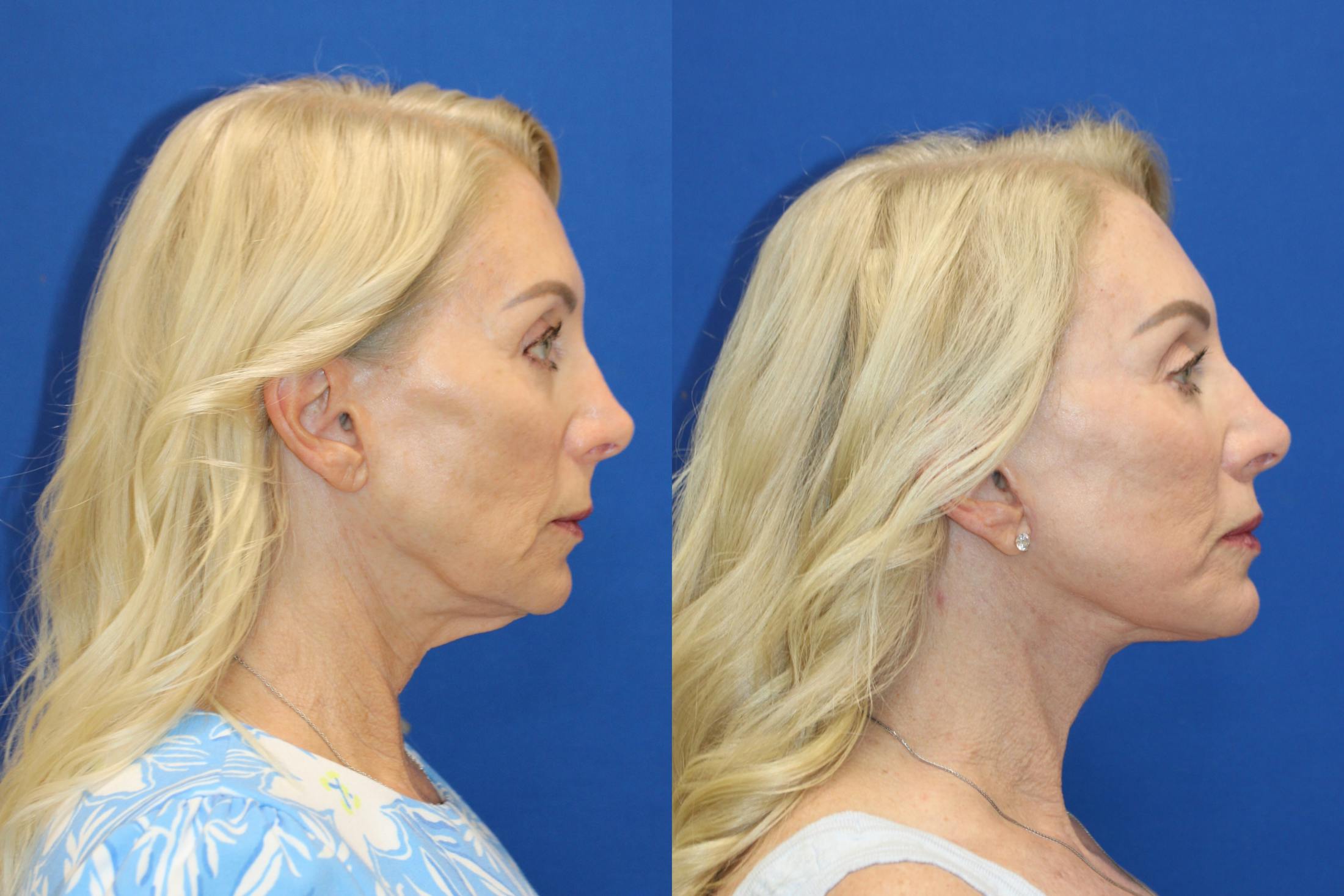 Vertical Restore® / Facial Rejuvenation Before & After Gallery - Patient 914685 - Image 4