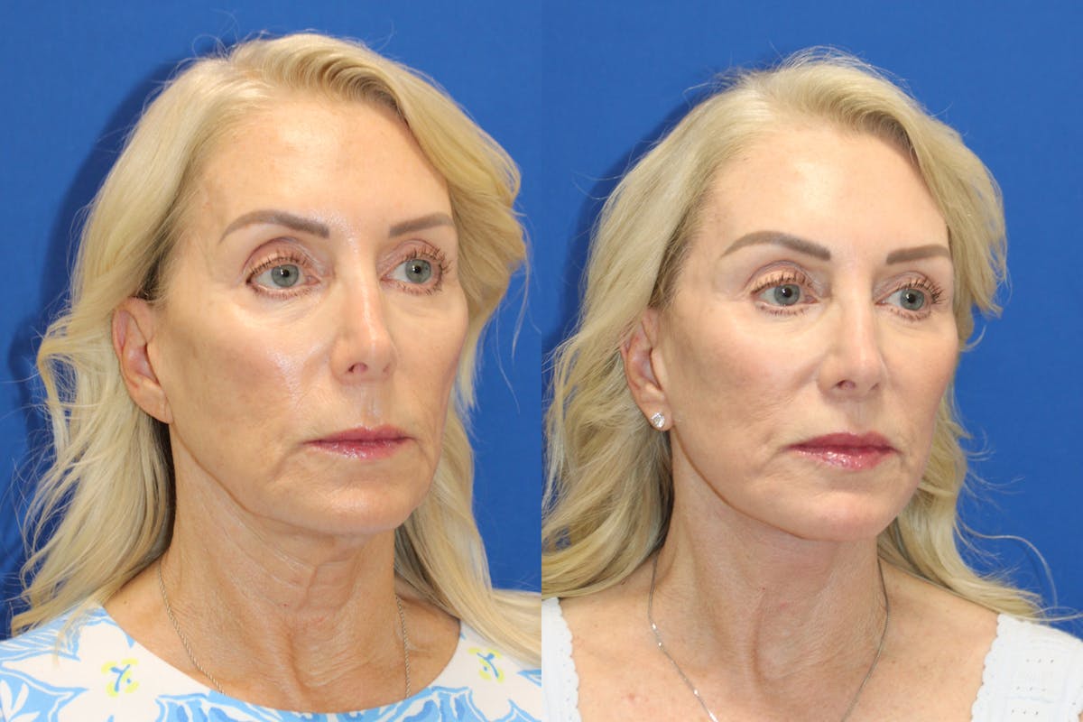 Vertical Restore® / Facial Rejuvenation Before & After Gallery - Patient 914685 - Image 3