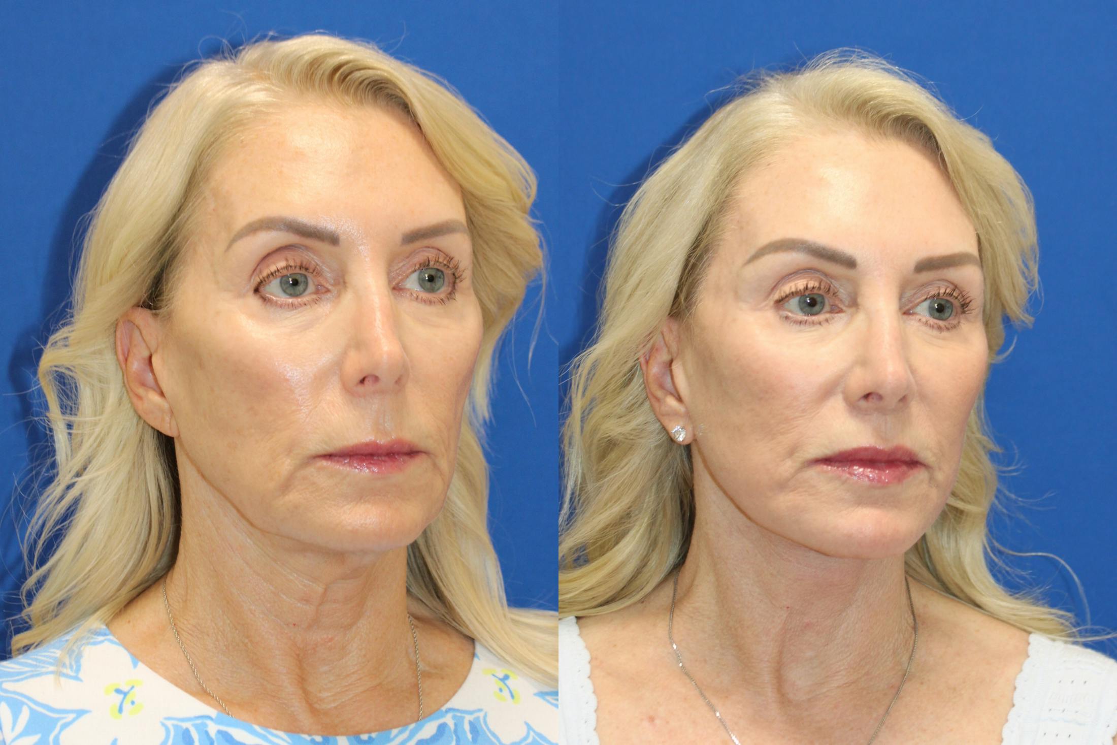 Vertical Restore® / Facial Rejuvenation Before & After Gallery - Patient 914685 - Image 3
