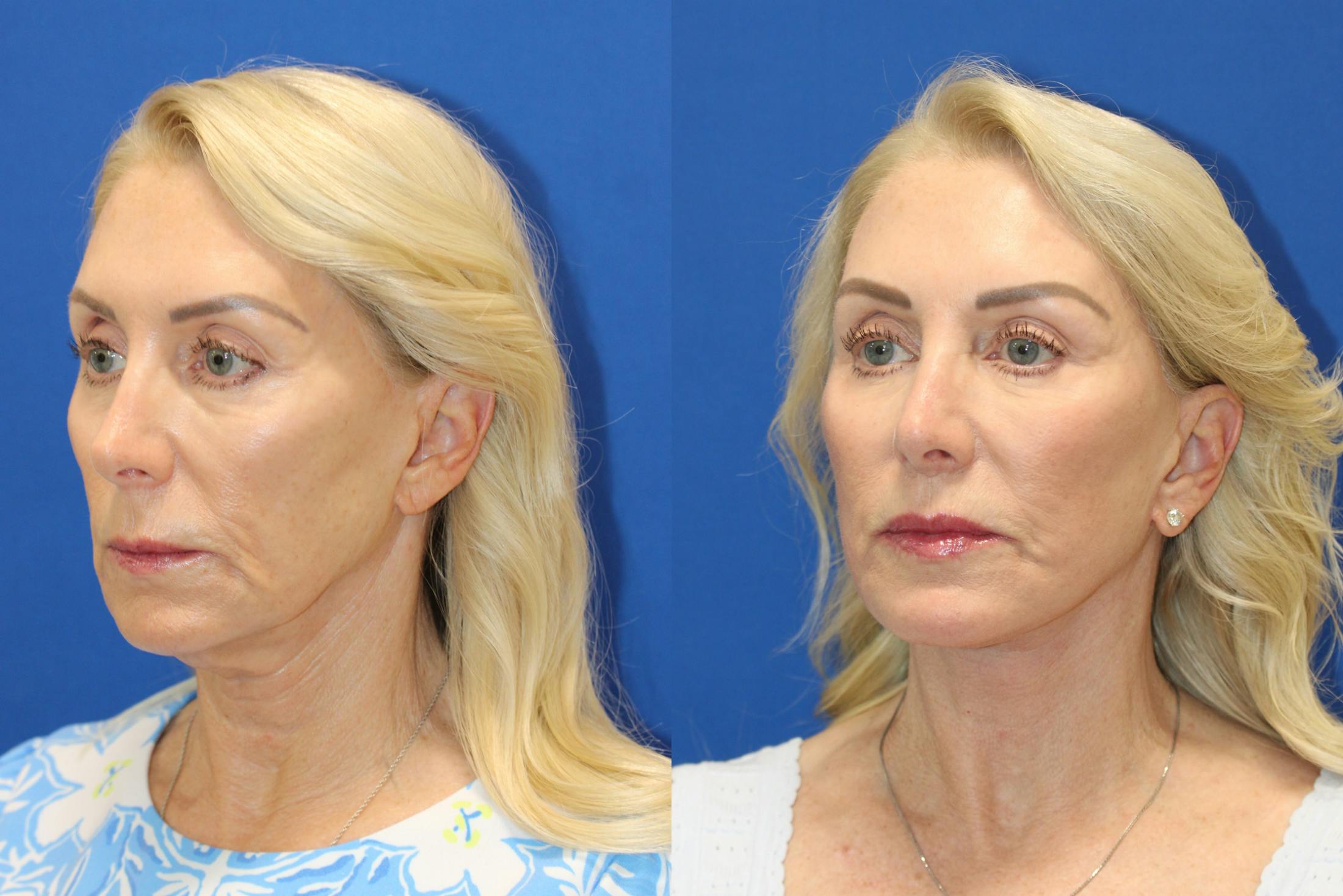 Vertical Restore® / Facial Rejuvenation Before & After Gallery - Patient 914685 - Image 5