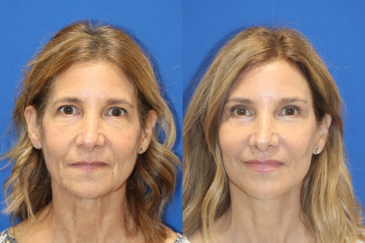 Vertical Restore® / Facial Rejuvenation Before & After Gallery - Patient 395784 - Image 7