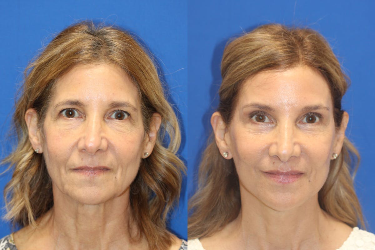 Vertical Restore® / Facial Rejuvenation Before & After Gallery - Patient 395784 - Image 1