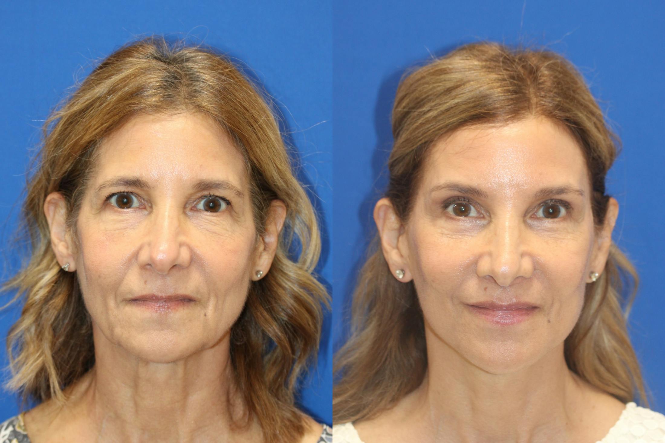 Vertical Restore® / Facial Rejuvenation Before & After Gallery - Patient 395784 - Image 1