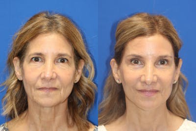 Vertical Restore® / Facial Rejuvenation Before & After Gallery - Patient 395784 - Image 1