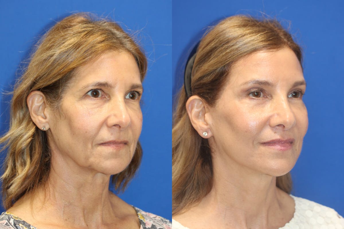 Vertical Restore® / Facial Rejuvenation Before & After Gallery - Patient 395784 - Image 4