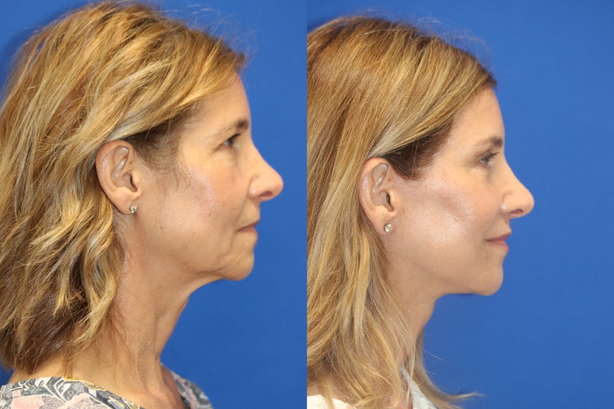 Vertical Restore® / Facial Rejuvenation Before & After Gallery - Patient 395784 - Image 5