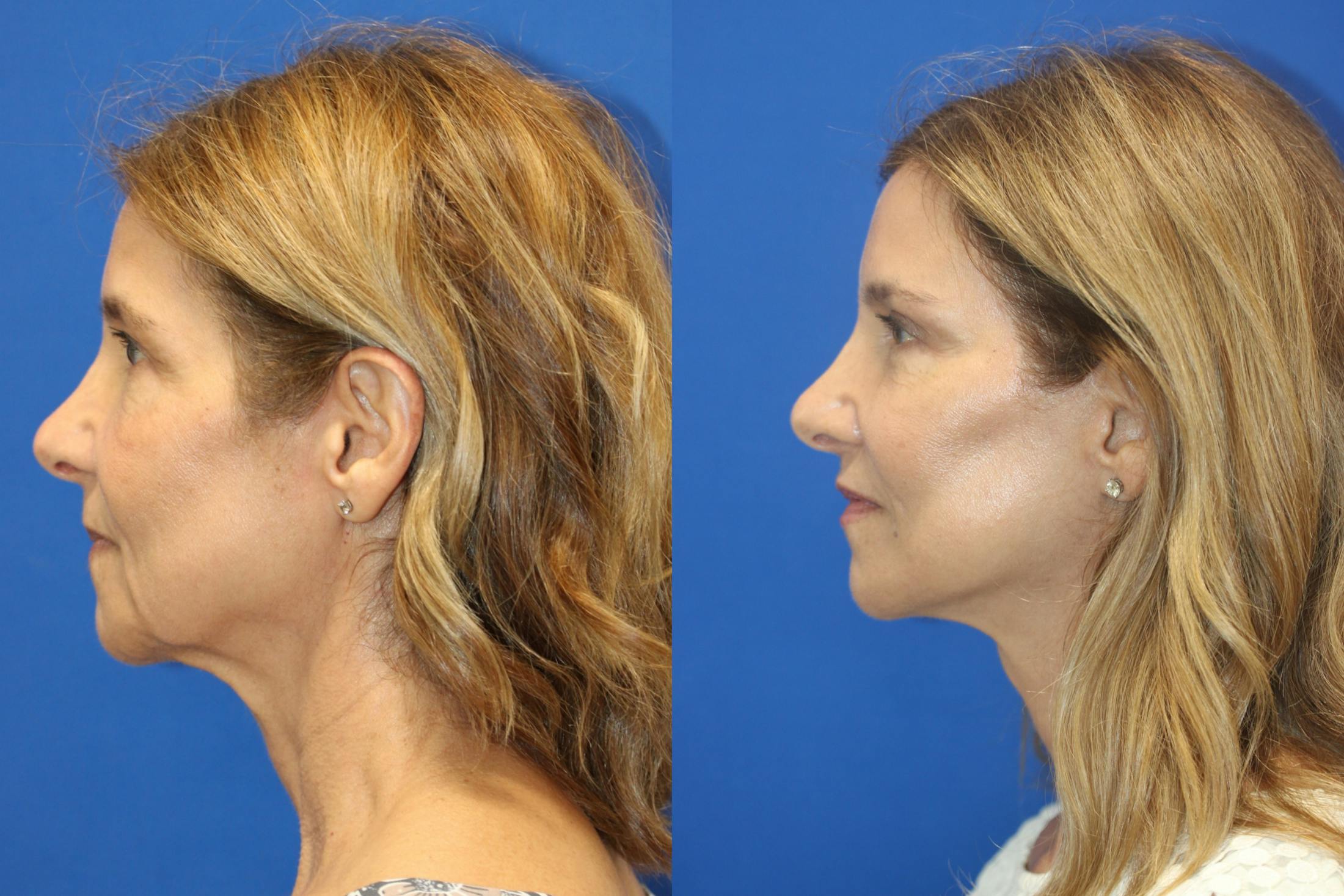 Vertical Restore® / Facial Rejuvenation Before & After Gallery - Patient 395784 - Image 2