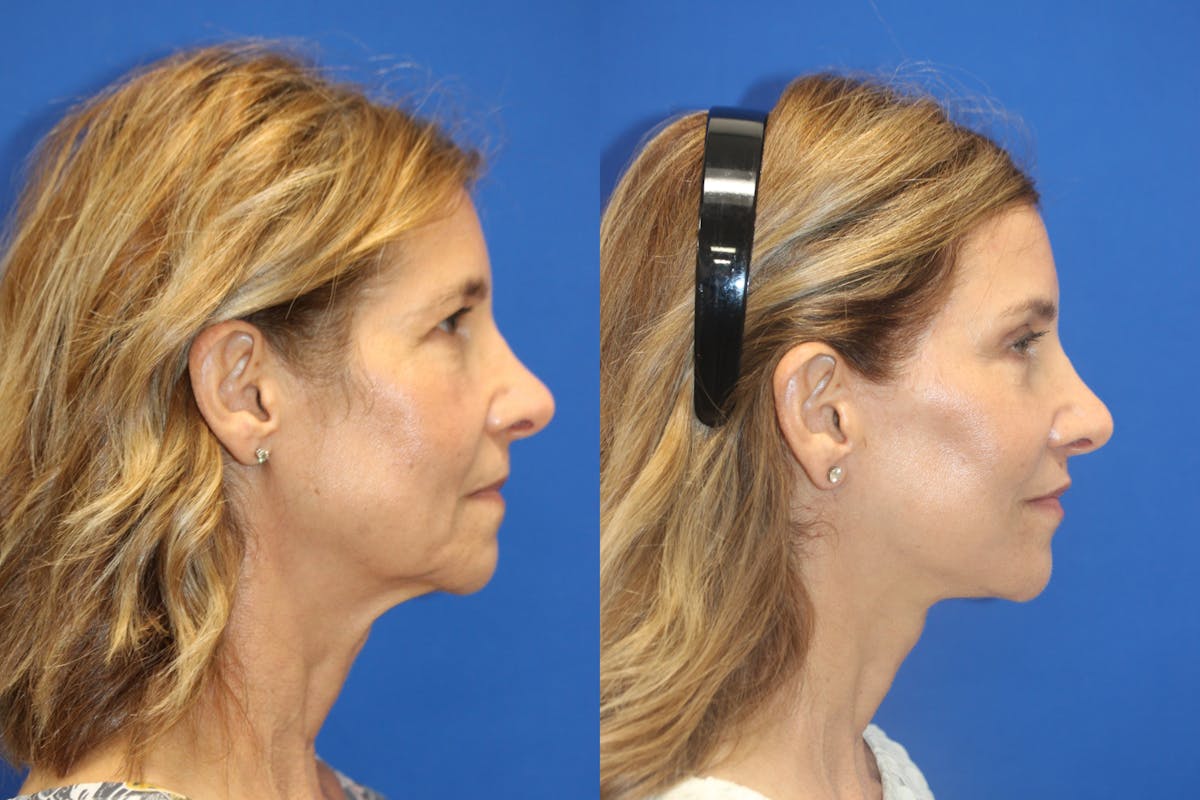 Vertical Restore® / Facial Rejuvenation Before & After Gallery - Patient 395784 - Image 6