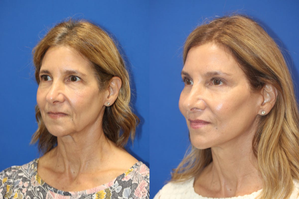 Vertical Restore® / Facial Rejuvenation Before & After Gallery - Patient 395784 - Image 3