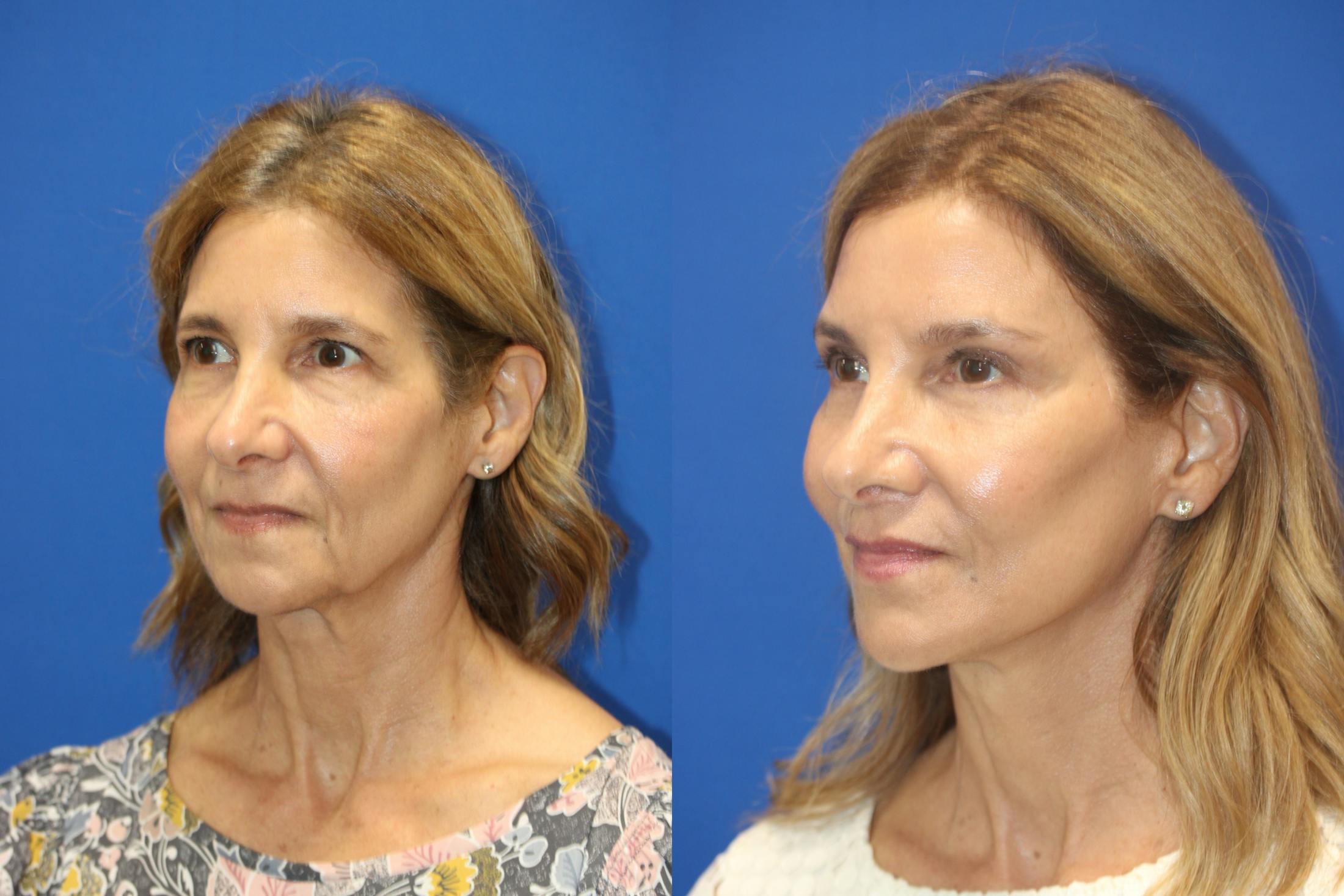 Vertical Restore® / Facial Rejuvenation Before & After Gallery - Patient 395784 - Image 3