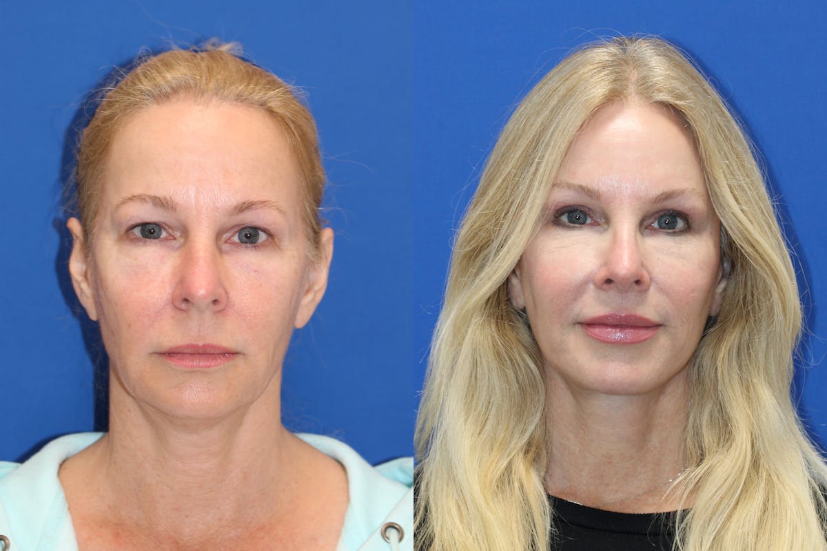 Vertical Restore® / Facial Rejuvenation Before & After Gallery - Patient 176105 - Image 1