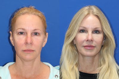 Vertical Restore® / Facial Rejuvenation Before & After Gallery - Patient 176105 - Image 1