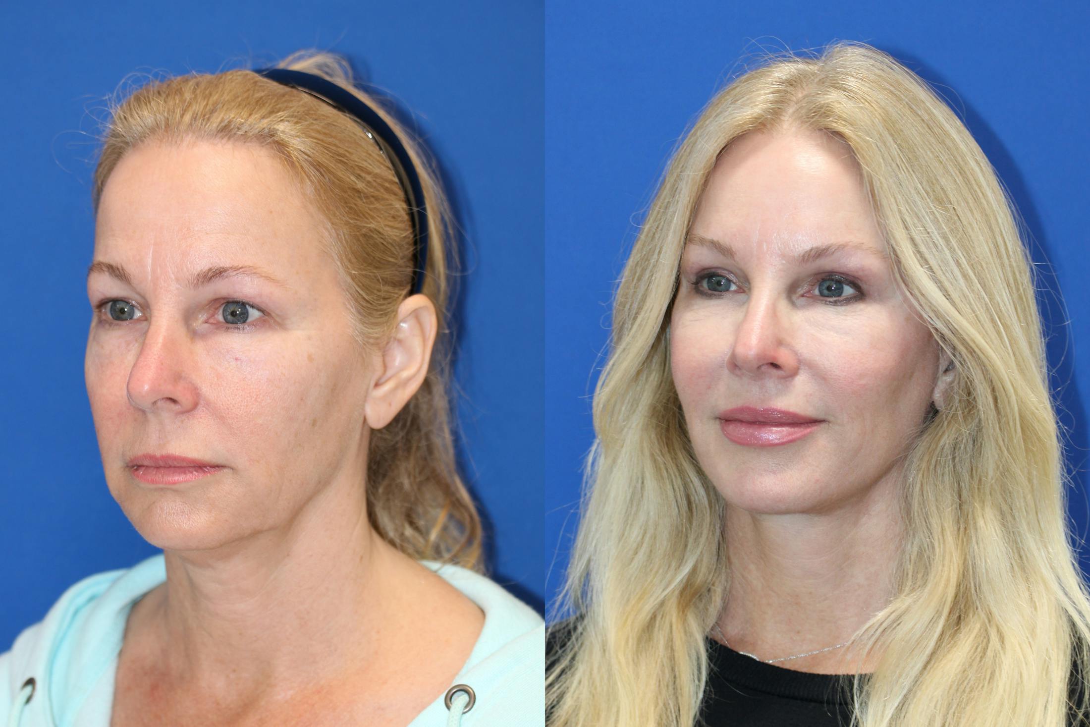 Vertical Restore® / Facial Rejuvenation Before & After Gallery - Patient 176105 - Image 2