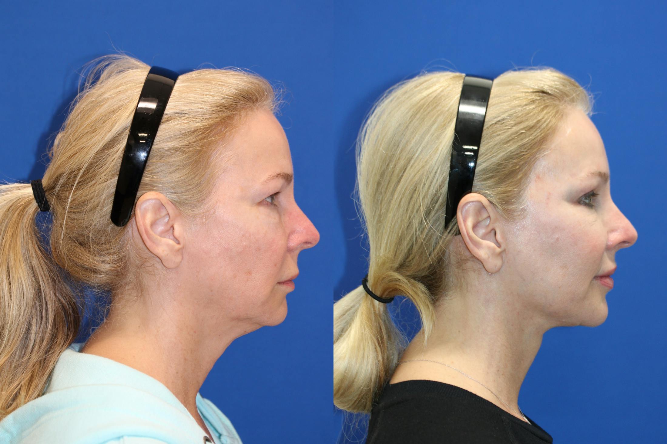 Vertical Restore® / Facial Rejuvenation Before & After Gallery - Patient 176105 - Image 7