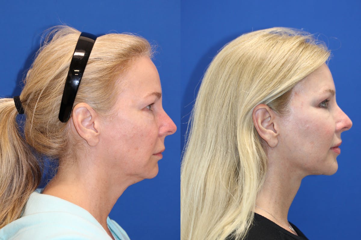 Vertical Restore® / Facial Rejuvenation Before & After Gallery - Patient 176105 - Image 6