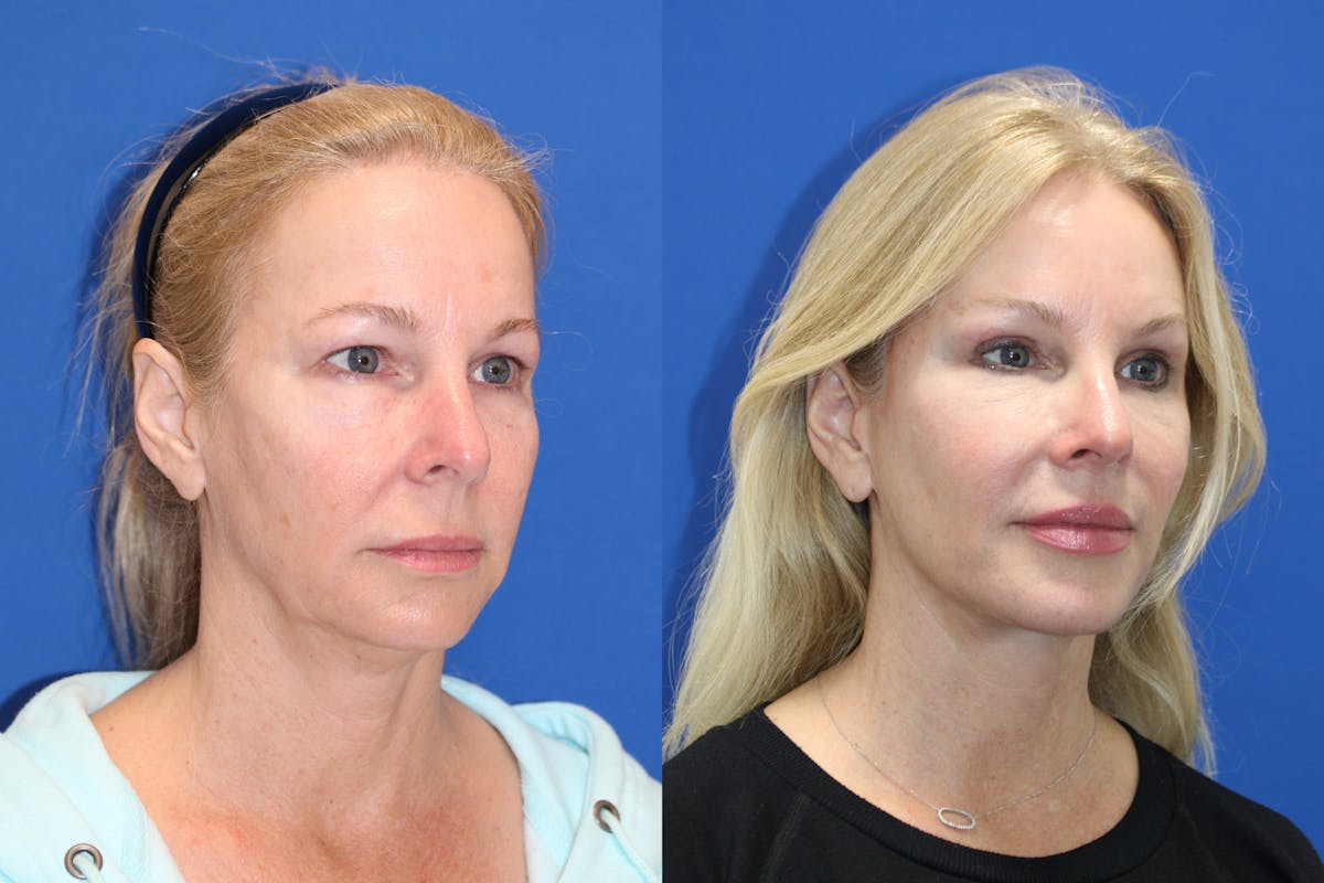 Vertical Restore® / Facial Rejuvenation Before & After Gallery - Patient 176105 - Image 4