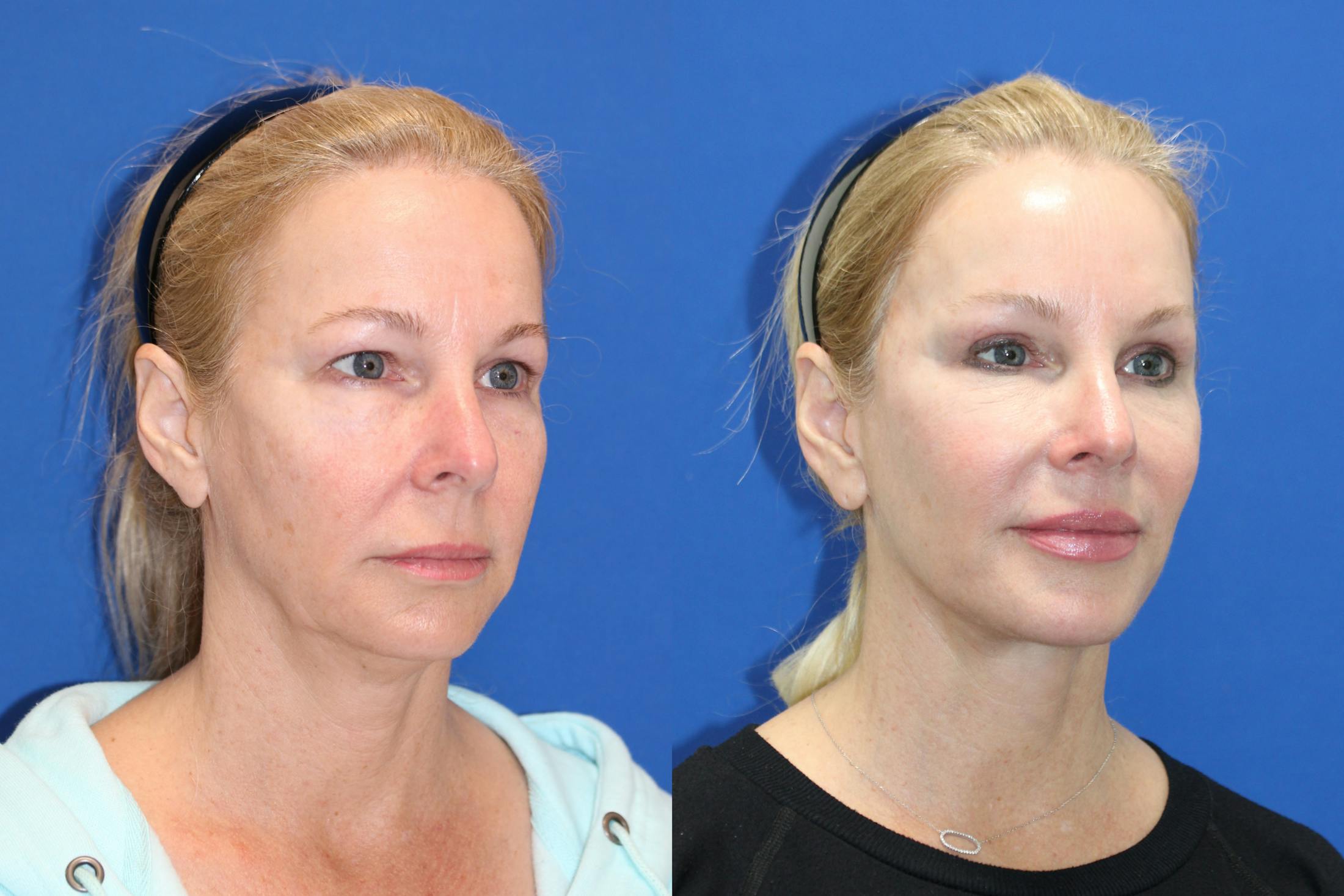 Vertical Restore® / Facial Rejuvenation Before & After Gallery - Patient 176105 - Image 5