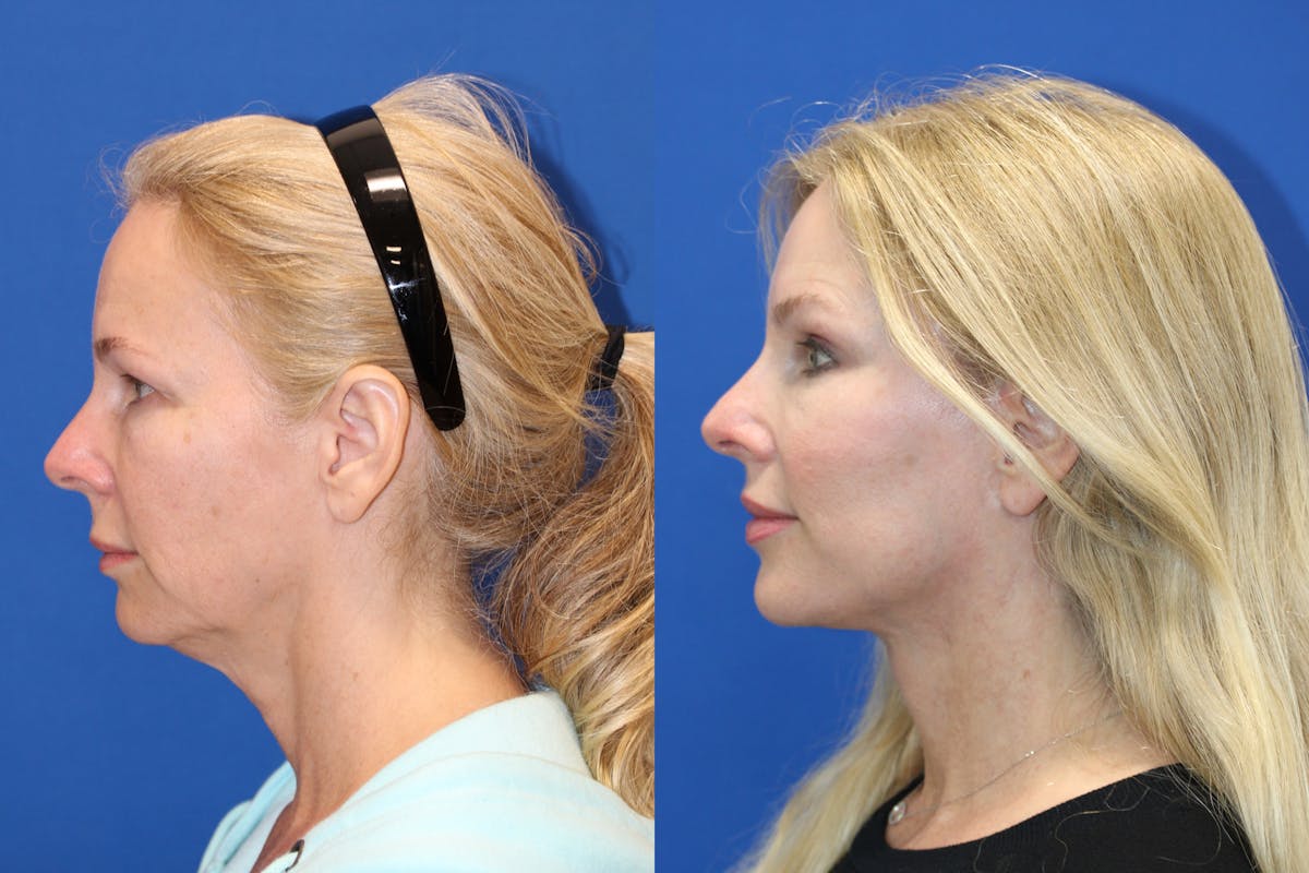 Vertical Restore® / Facial Rejuvenation Before & After Gallery - Patient 176105 - Image 3