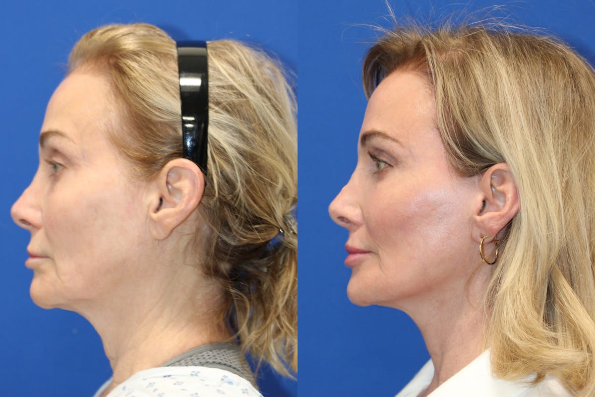 Vertical Restore® / Facial Rejuvenation Before & After Gallery - Patient 341311 - Image 3