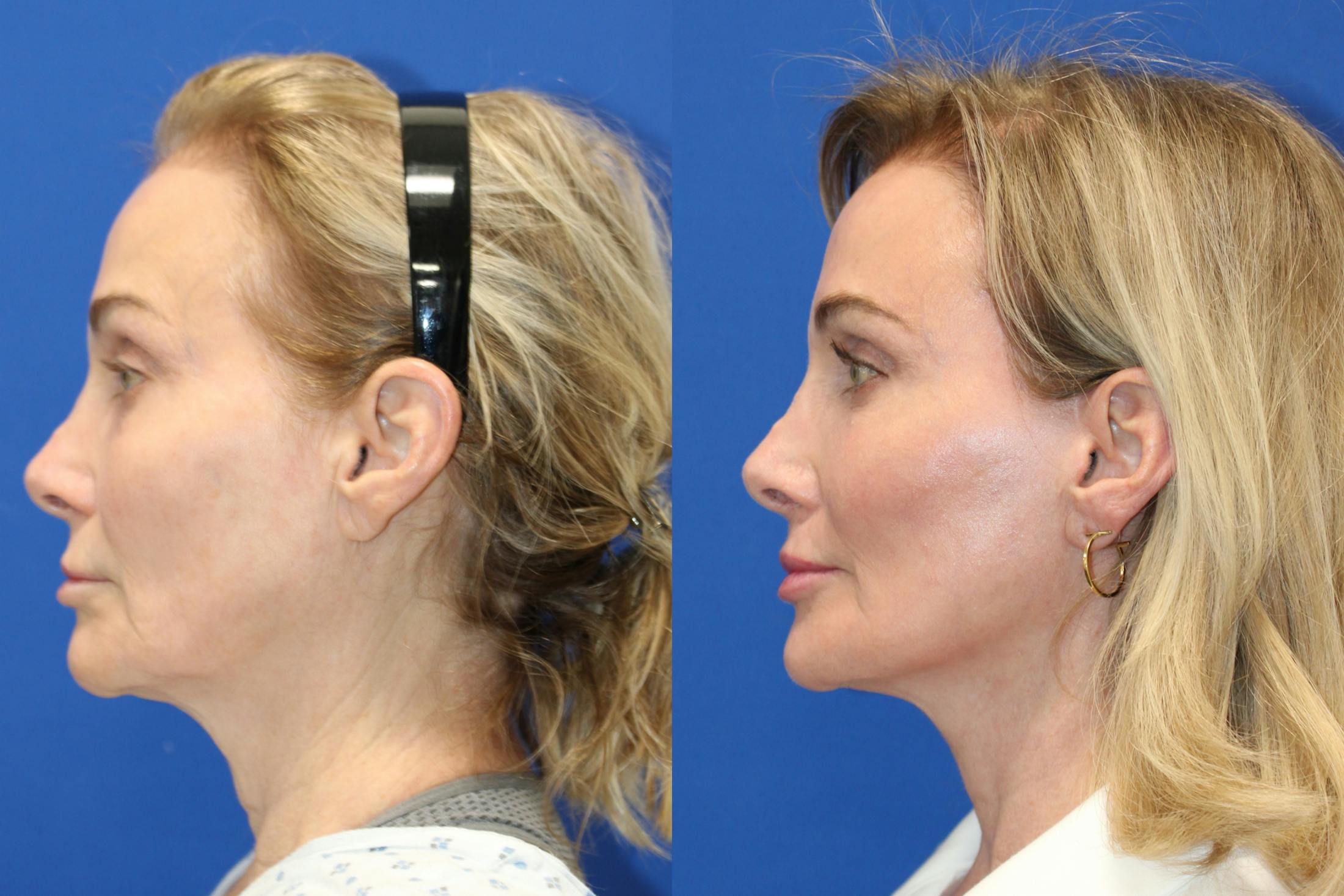 Vertical Restore® / Facial Rejuvenation Before & After Gallery - Patient 341311 - Image 3