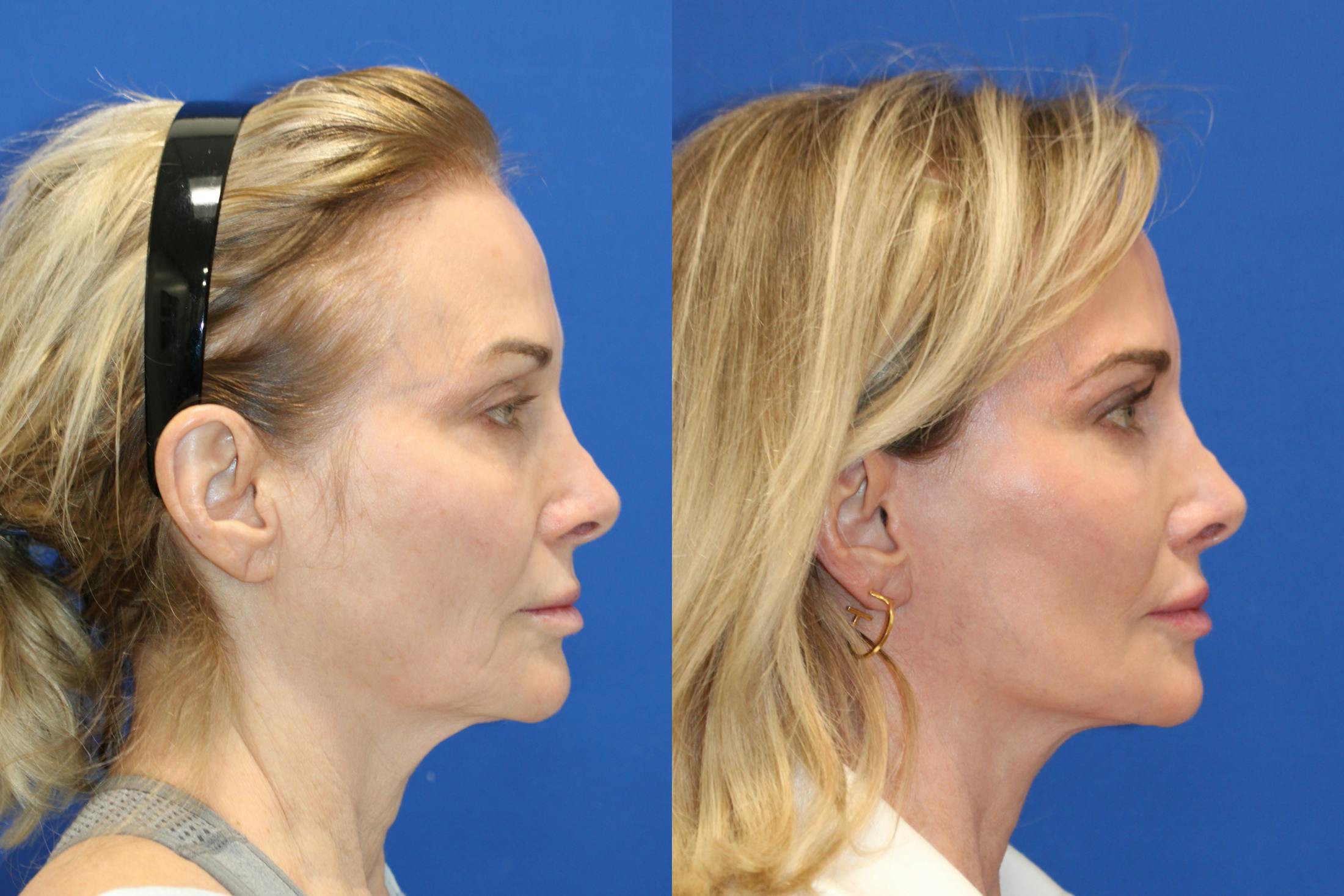 Vertical Restore® / Facial Rejuvenation Before & After Gallery - Patient 341311 - Image 4