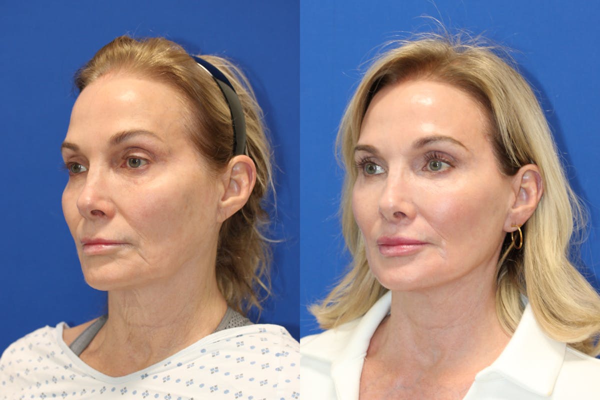 Vertical Restore® / Facial Rejuvenation Before & After Gallery - Patient 341311 - Image 2