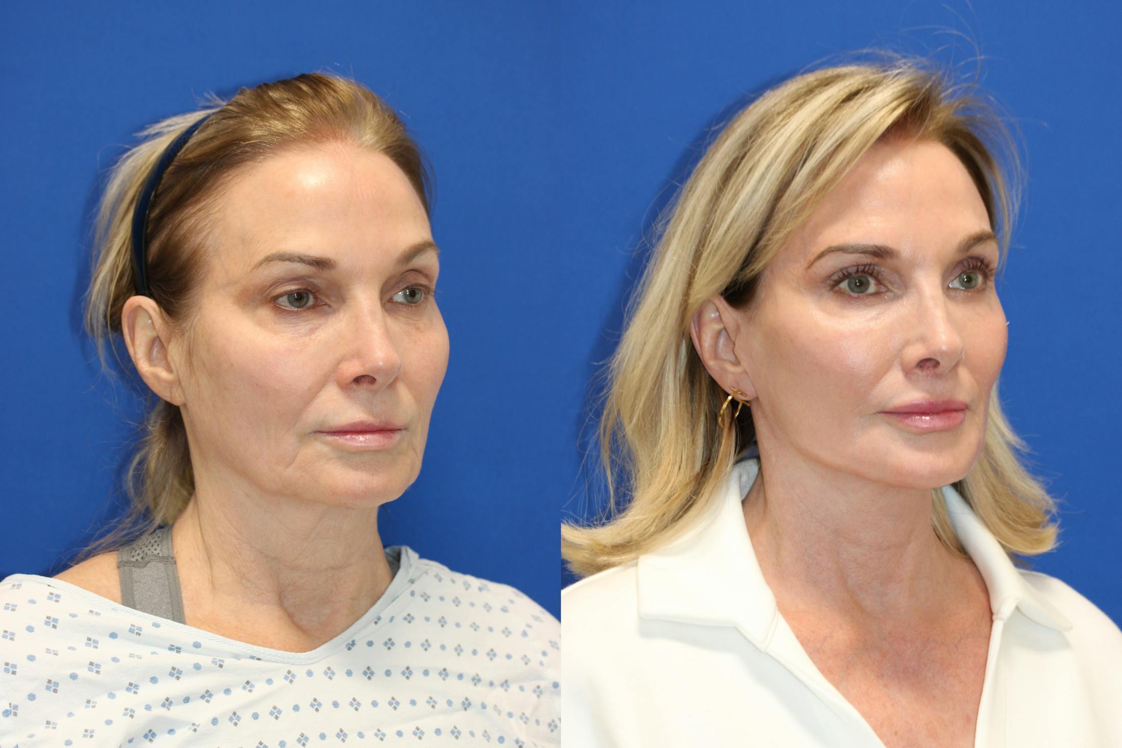 Vertical Restore® / Facial Rejuvenation Before & After Gallery - Patient 341311 - Image 5