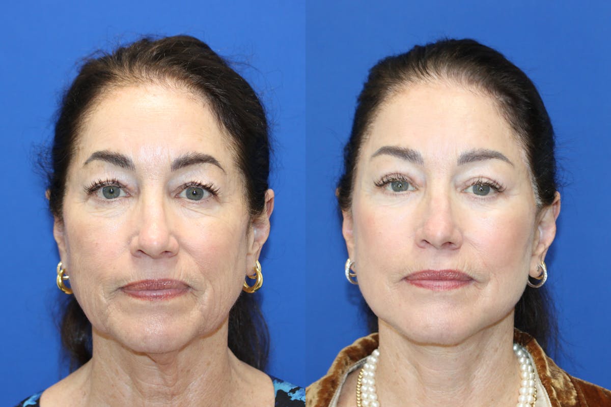 Vertical Restore® / Facial Rejuvenation Before & After Gallery - Patient 272326 - Image 1