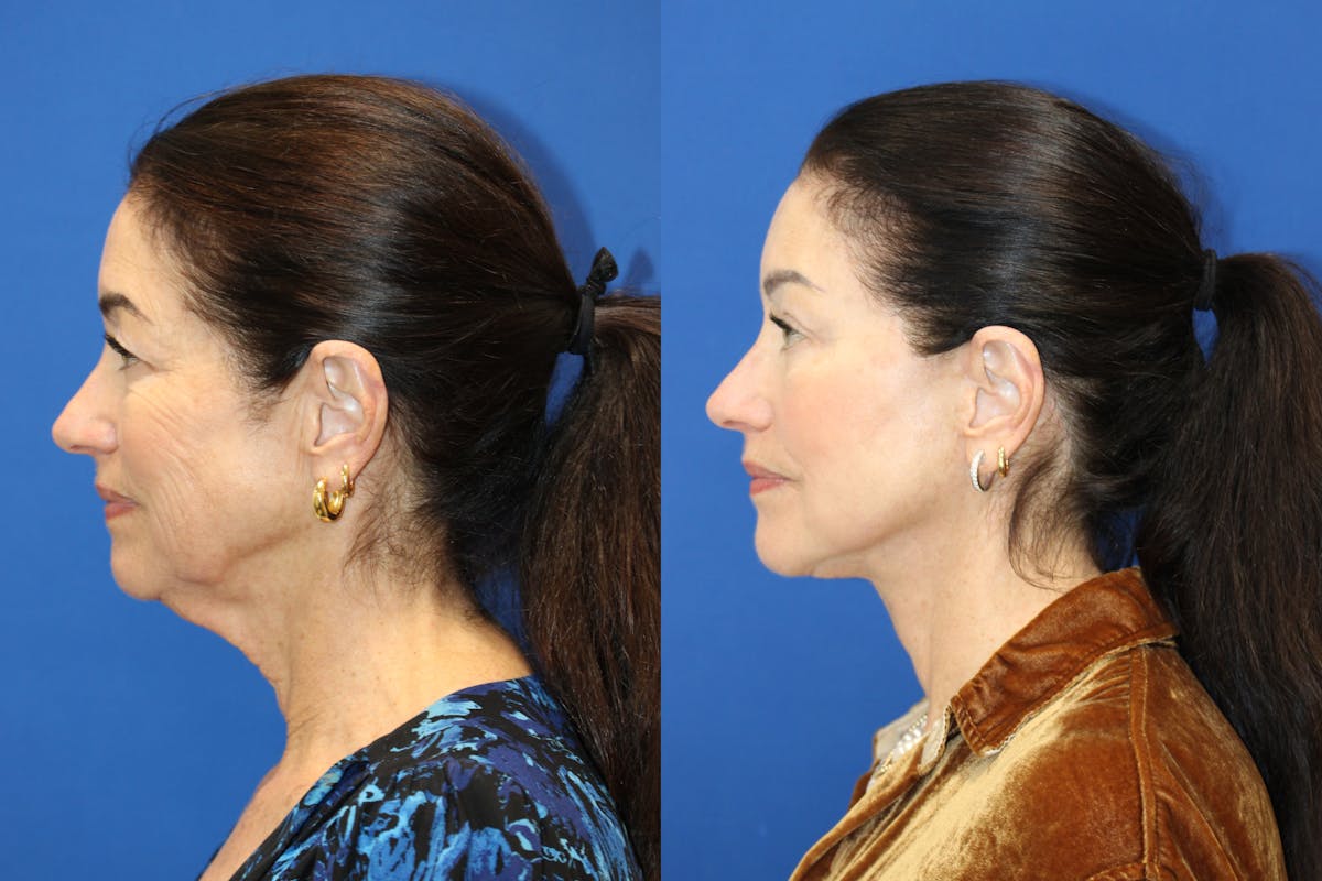 Vertical Restore® / Facial Rejuvenation Before & After Gallery - Patient 272326 - Image 5