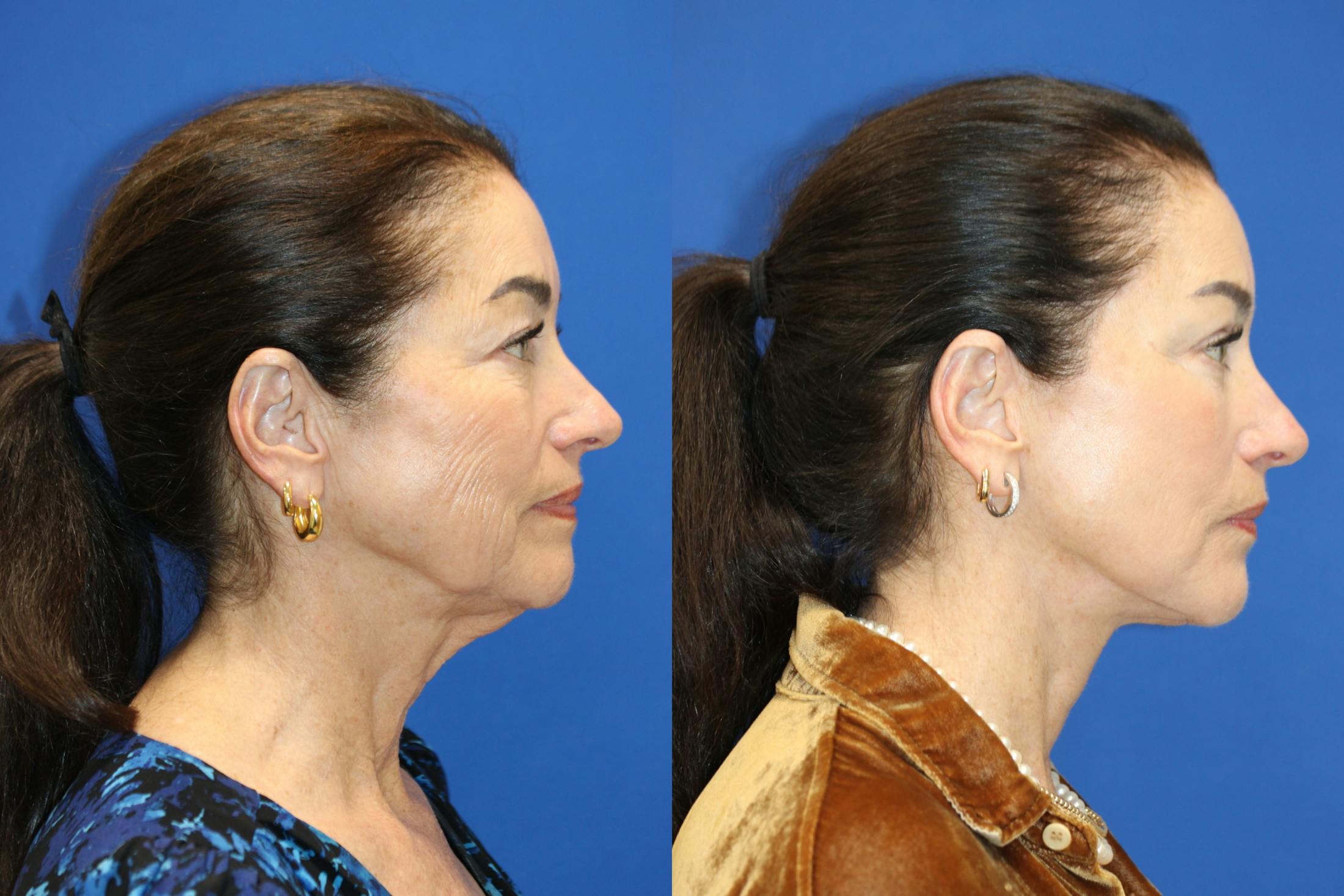 Vertical Restore® / Facial Rejuvenation Before & After Gallery - Patient 272326 - Image 4