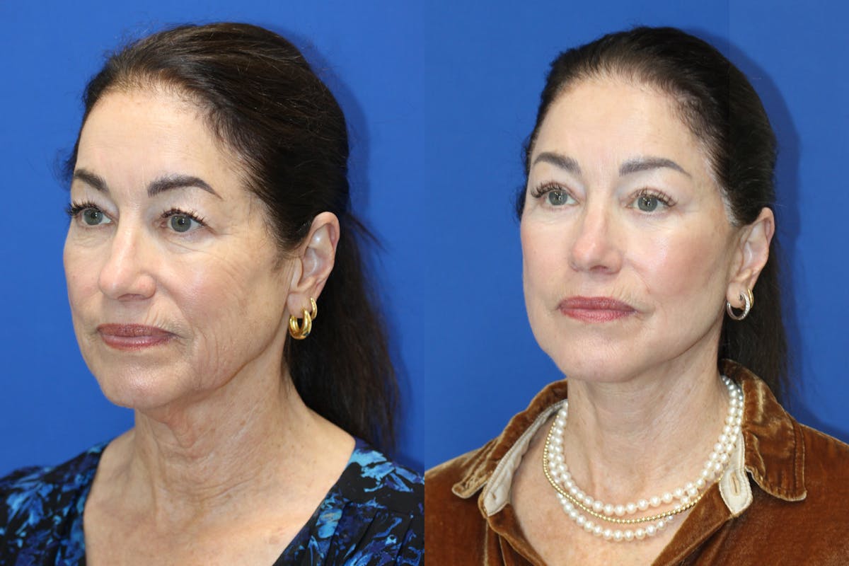 Vertical Restore® / Facial Rejuvenation Before & After Gallery - Patient 272326 - Image 2