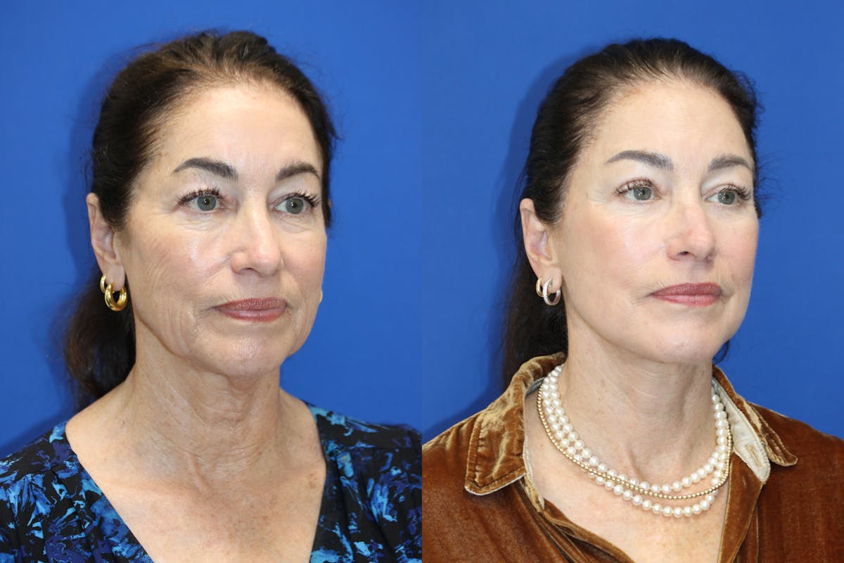 Vertical Restore® / Facial Rejuvenation Before & After Gallery - Patient 272326 - Image 3