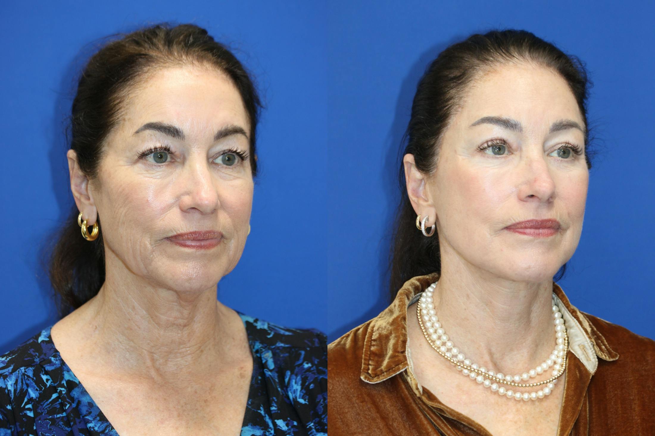 Vertical Restore® / Facial Rejuvenation Before & After Gallery - Patient 272326 - Image 3