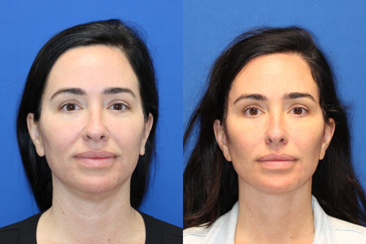 Vertical Restore® / Facial Rejuvenation Before & After Gallery - Patient 199030 - Image 1