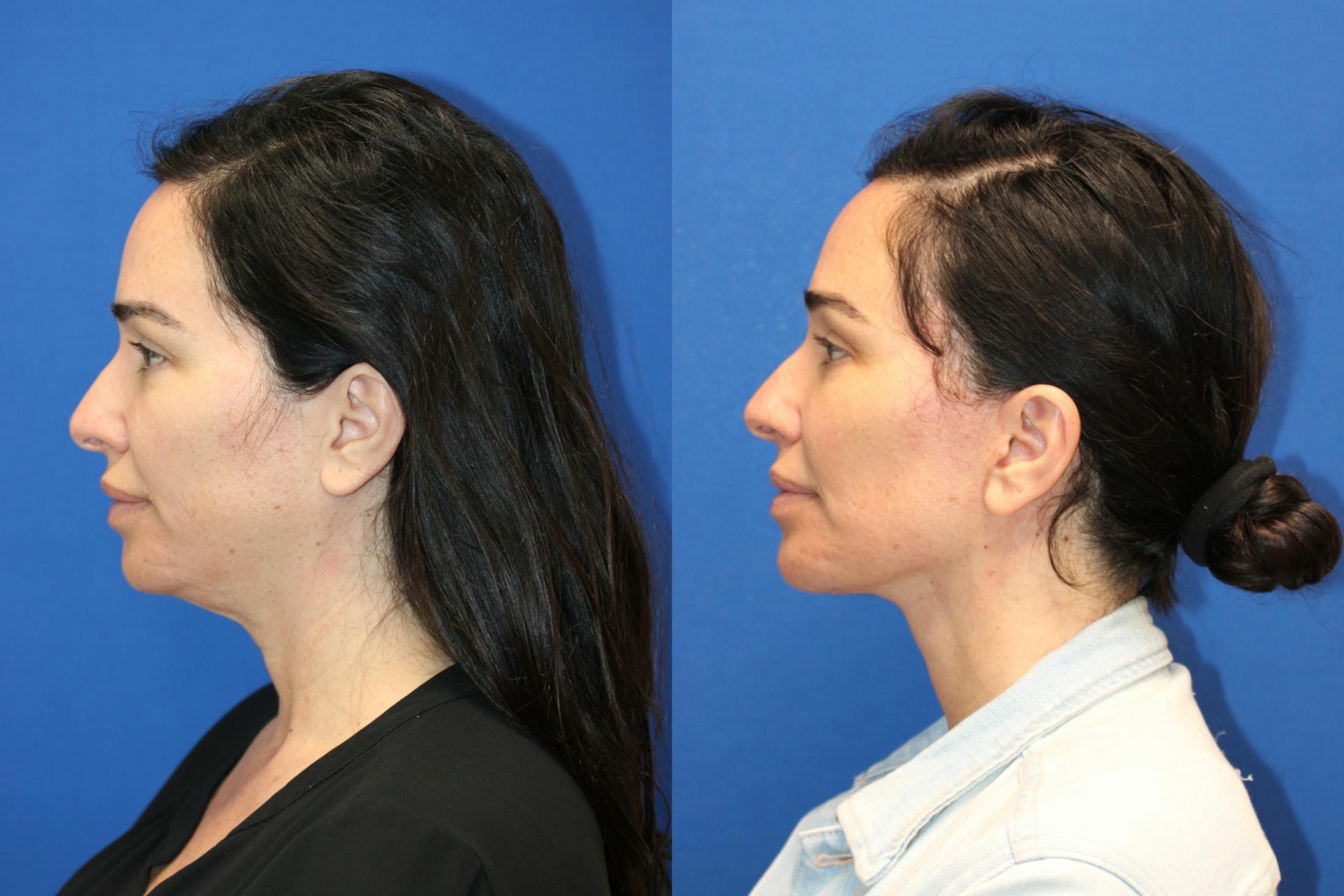 Vertical Restore® / Facial Rejuvenation Before & After Gallery - Patient 199030 - Image 3