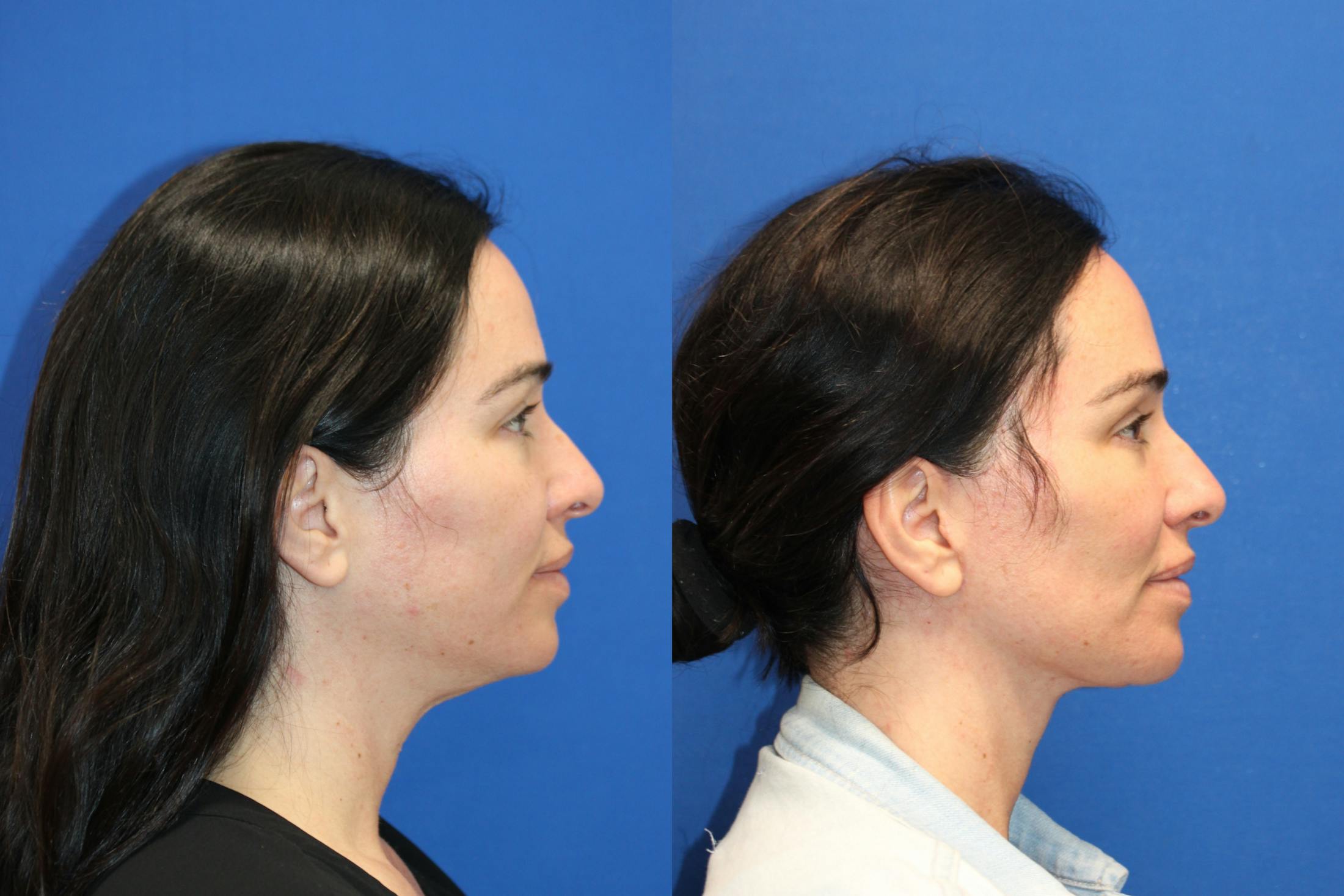 Vertical Restore® / Facial Rejuvenation Before & After Gallery - Patient 199030 - Image 4