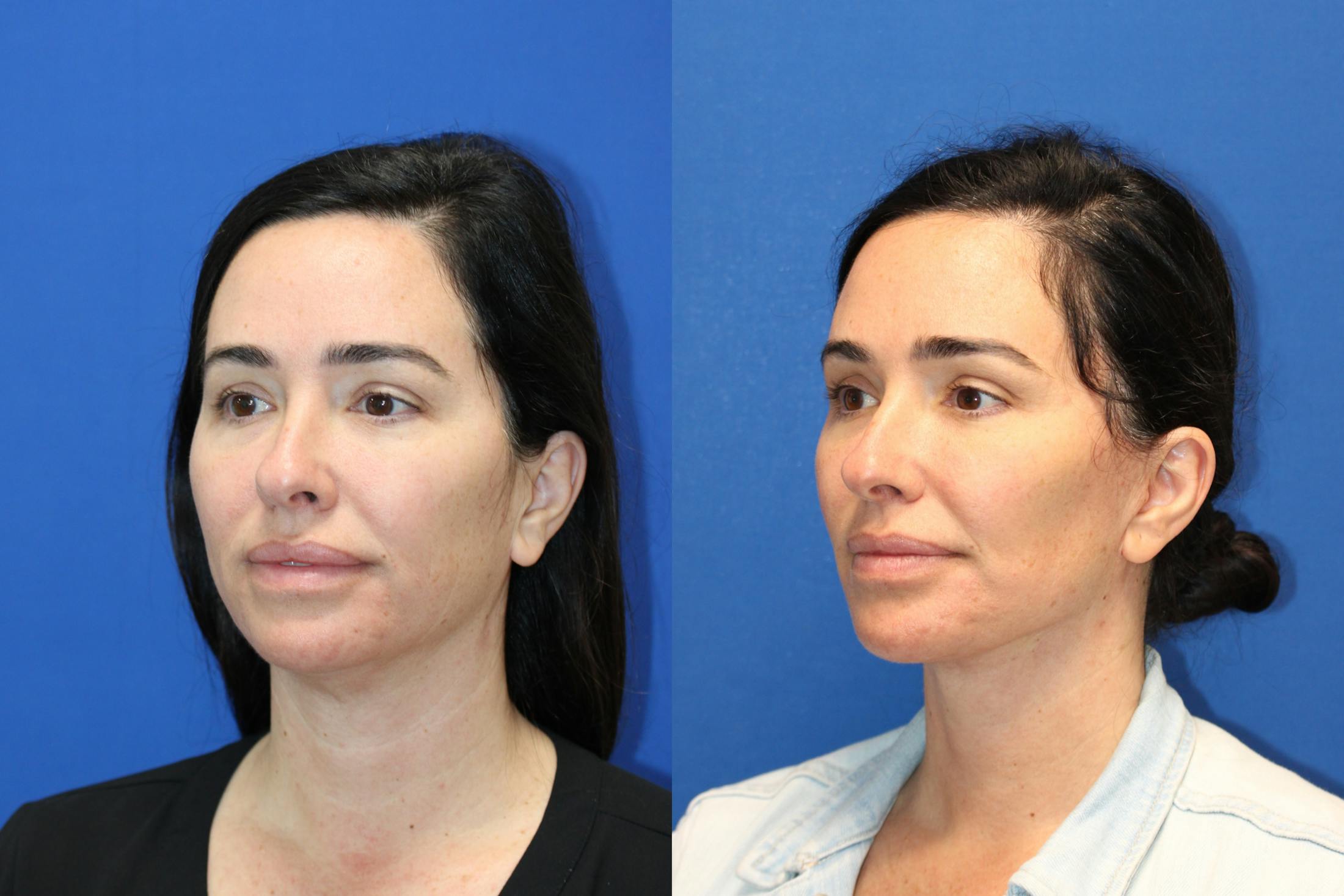 Vertical Restore® / Facial Rejuvenation Before & After Gallery - Patient 199030 - Image 5