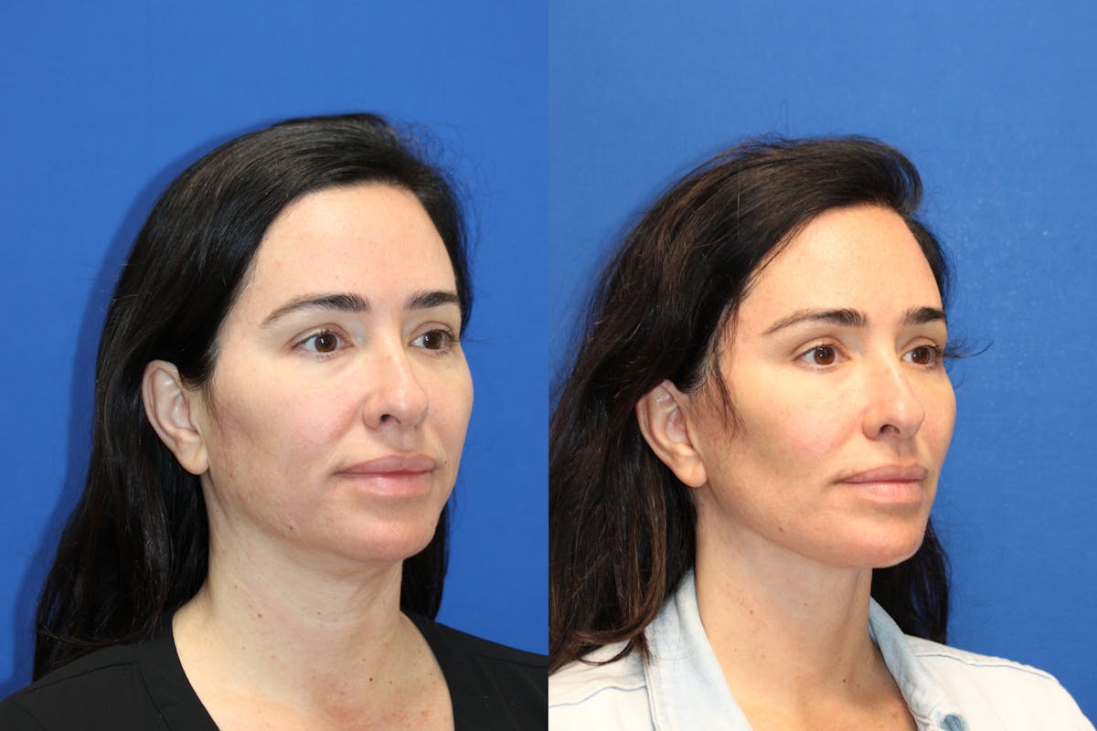 Vertical Restore® / Facial Rejuvenation Before & After Gallery - Patient 199030 - Image 2