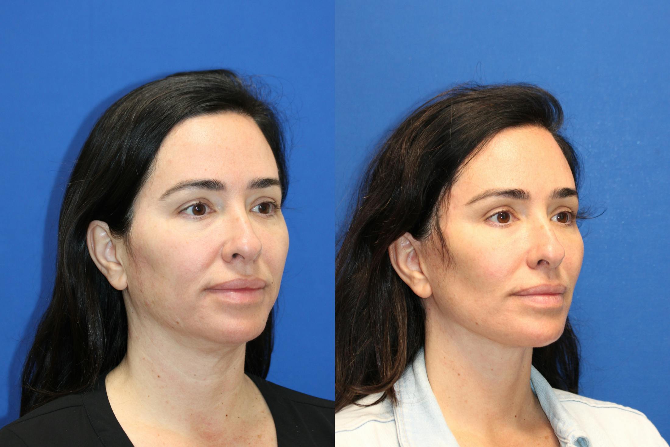 Vertical Restore® / Facial Rejuvenation Before & After Gallery - Patient 199030 - Image 2
