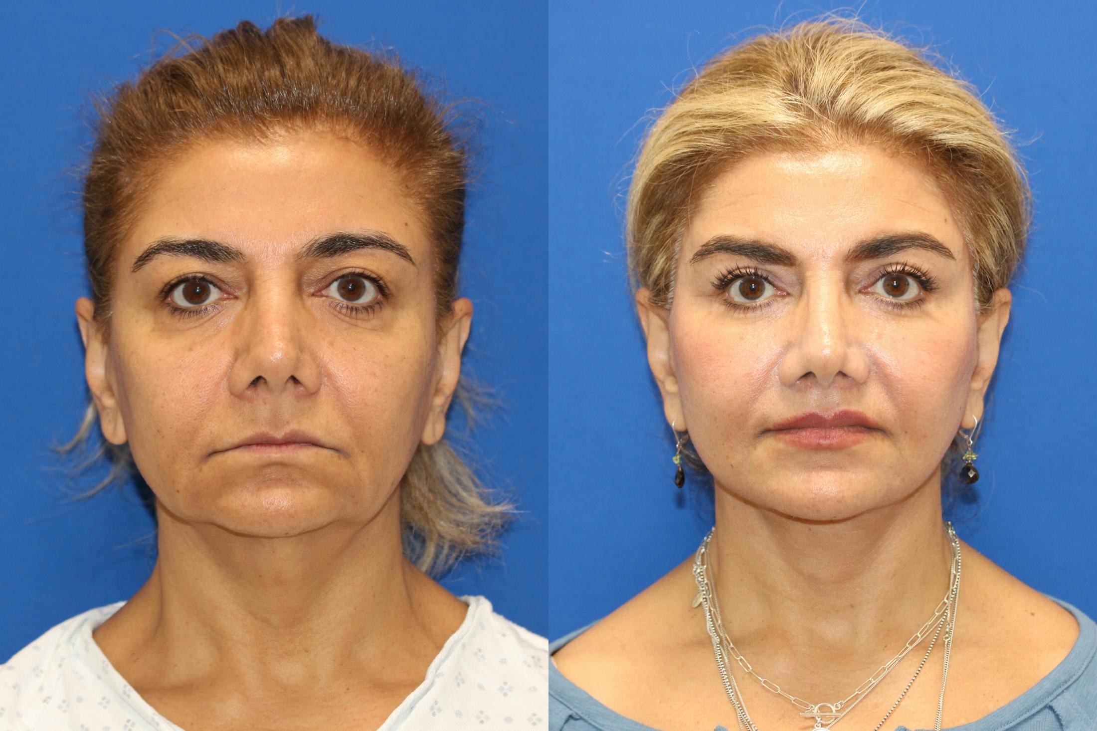 Vertical Restore® / Facial Rejuvenation Before & After Gallery - Patient 148561605 - Image 1