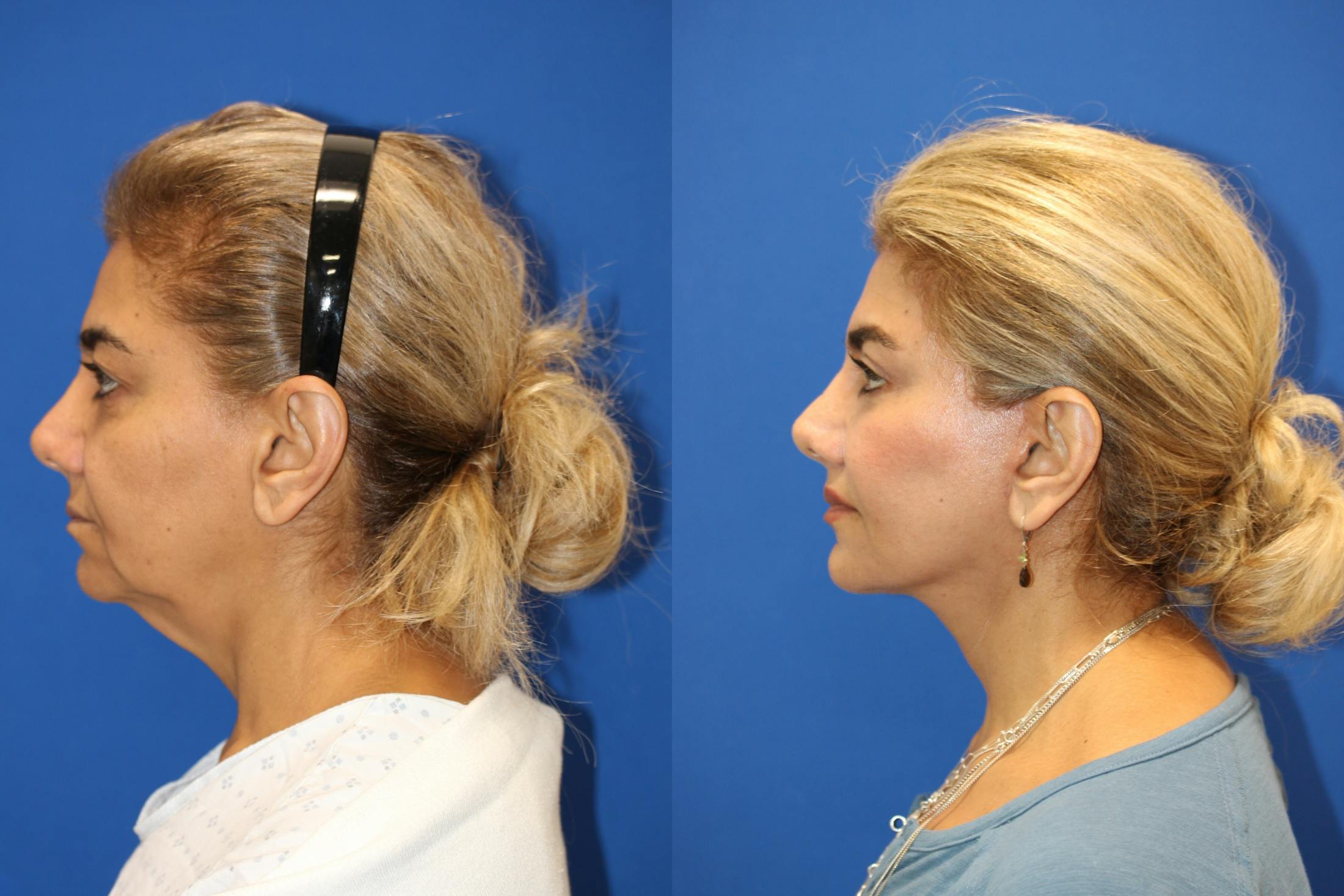 Vertical Restore® / Facial Rejuvenation Before & After Gallery - Patient 148561605 - Image 3