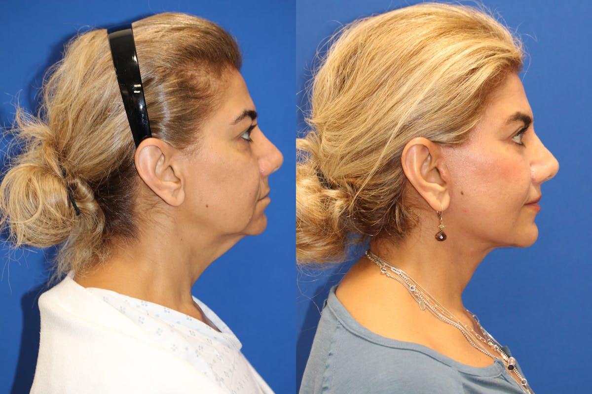 Vertical Restore® / Facial Rejuvenation Before & After Gallery - Patient 148561605 - Image 5