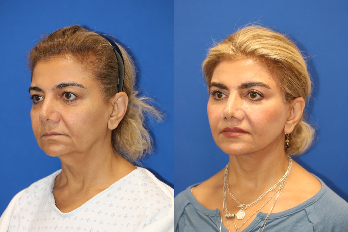Vertical Restore® / Facial Rejuvenation Before & After Gallery - Patient 148561605 - Image 2
