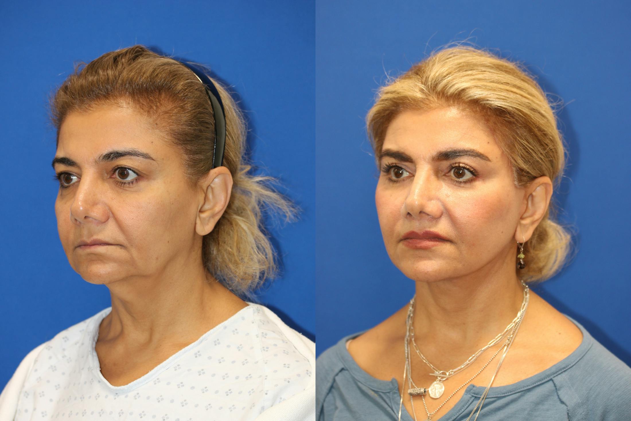 Vertical Restore® / Facial Rejuvenation Before & After Gallery - Patient 148561605 - Image 2