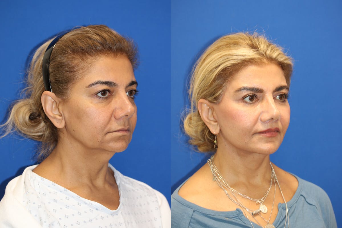 Vertical Restore® / Facial Rejuvenation Before & After Gallery - Patient 148561605 - Image 4